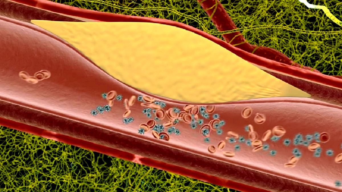 Wylew czy udar. Grafika przedstawia przekrój naczynia krwionośnego z przewężeniem spowodowanym przez tłuszcz.