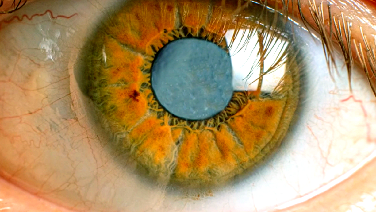 Zaćma - objawy przyczyny leczenie - zbliżenie na piwne oko, cała widoczna spod tęczówki, soczewka jest mleczno-biała