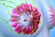Jak rozpoznać raka piersi, pierś z wyszczególnionym nowotworem