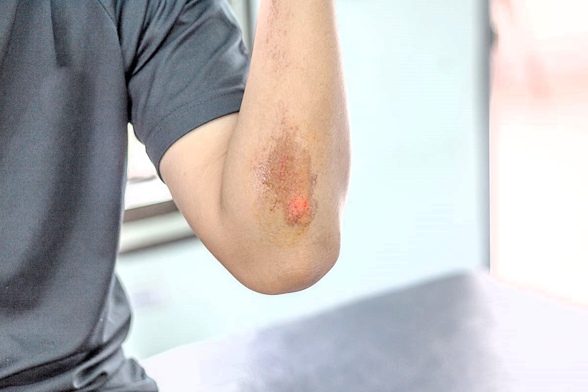 Maść na otarcia – jaką maść na podrażnienia skóry wybrać?